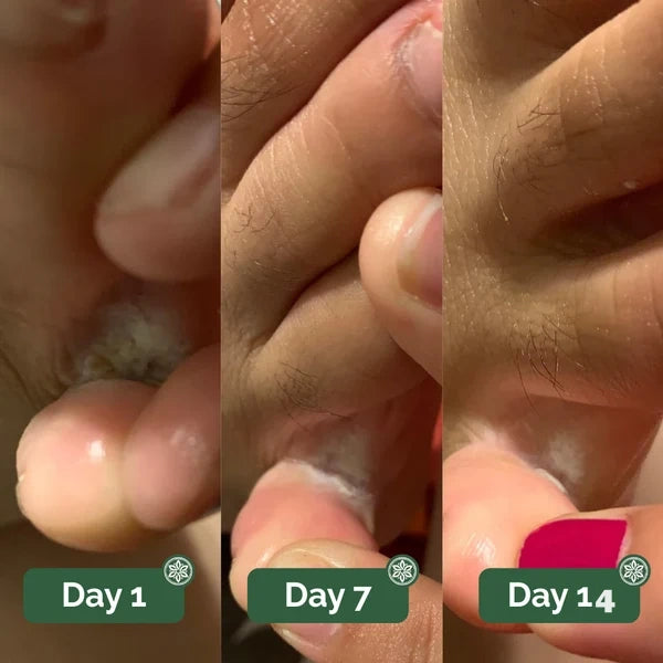 Athlete’s foot between toes showing visible improvement from Day 1 to Day 14 with consistent foot care