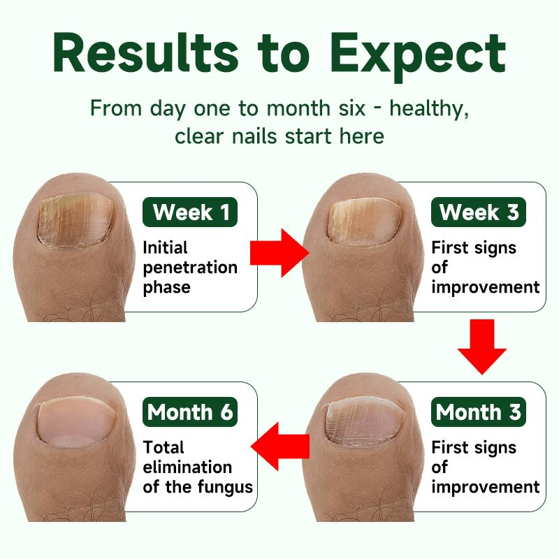 【Buy 1 get 1 free】Medical-Grade Nail Fungus Pen -Deep Sterilization Prevent Recurrence for Optimal Nail Health Therapy Treatment TikTokShopBlackFriday foot fungal repair Toenails Eliminate Fungi