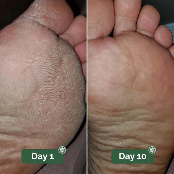 Athlete’s foot before and after 10 days of consistent foot care showing reduced dry and flaky skin