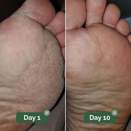 Athlete’s foot before and after 10 days of consistent foot care showing reduced dry and flaky skin