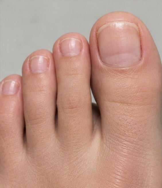 Clearer-looking toenails after eight weeks of nail care