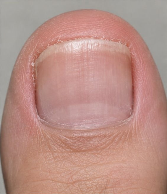 Smoother-looking toenail after eight weeks of nail care