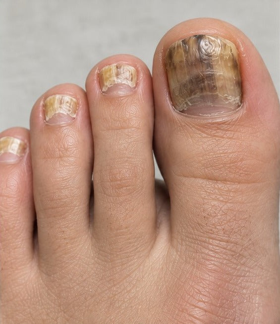 Yellow, discolored toenails before a nail-care routine