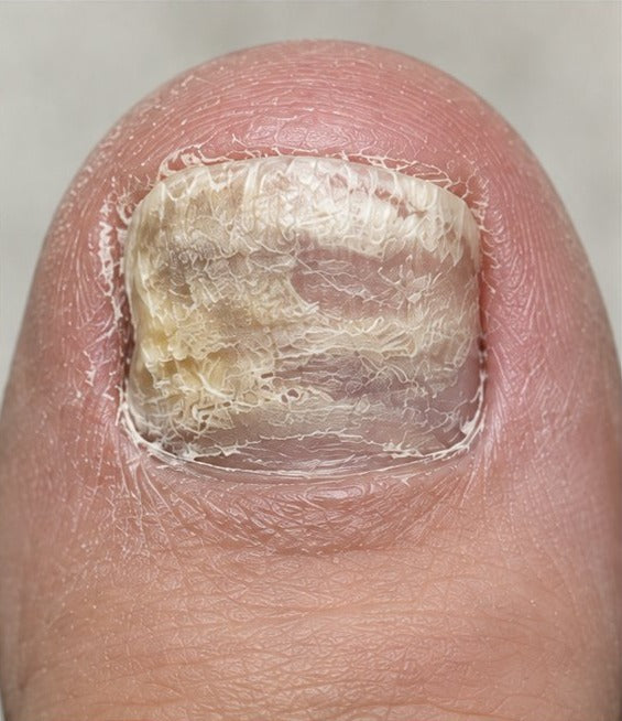 Rough, damaged toenail before a nail-care routine